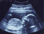 No Fetal Pain Before 24 Weeks: Who are they kidding?
