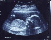 No Fetal Pain Before 24 Weeks: Who are they kidding?